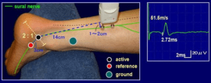 Fisioterapia y electromiografía en patología neuromuscular 1 2024