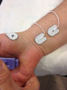 Fisioterapia y electromiografía en patología neuromuscular 2 2025