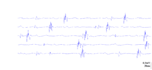 Fisioterapia y electromiografía en patología neuromuscular 3 2025