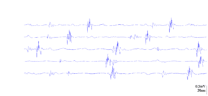 Fisioterapia y electromiografía en patología neuromuscular 3 2024