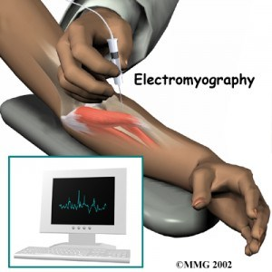 Fisioterapia y electromiografía en patología neuromuscular 4 2025