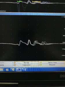 Fisioterapia y electromiografía en patología neuromuscular 6 2025