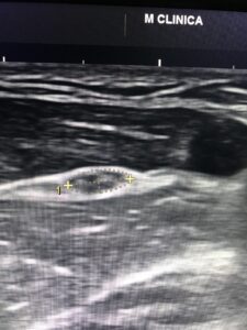 Fisioterapia y electromiografía en patología neuromuscular 7 2025