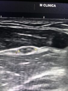 Fisioterapia y electromiografía en patología neuromuscular 7 2024